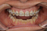 Fig 7. Mid-orthodontic treatment showing proper spacing being re-established for Nos. 7 through 10.
