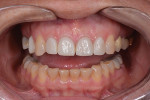 Fig 8. Orthodontic treatment completed showing Nos. 7 through 10 intruded, harmonious gingival levels, and straightened mandibular anterior teeth.