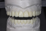 Fig 9. Diagnostic wax-up with proper teeth width and incisal edge positions.