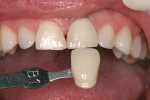 Figure 5  The shade tab in the photograph allows the laboratory technician to gauge the true color of the teeth and the preparations.