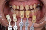 Fig 11. Prepared maxillary teeth Nos. 3 through 7 and 10 through 14 with dentin shade guide.