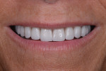 Fig 13. Close-up view of patient’s smile, post-treatment.