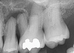 Fig 1. Patient presented with pain in the maxillary left posterior region, which radiographically had a large periapical area associated with the apical of the second premolar and the mesiobuccal apical of the first molar and probing depths of ≥10 mm interproximally.