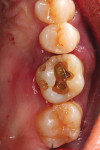 Fig 2. Existing amalgam restorations were removed from the first molar prior to extraction.
