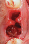 Fig 3. Extraction sockets were thoroughly debrided to remove any of the apical cyst.
