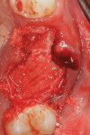Fig 5. Amnion-chorion membrane was placed over the dentin graft and tucked under the flap margins prior to suture placement.