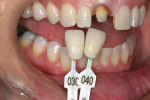 Figure 6  The shade tab in the photograph allows the laboratory technician to gauge the true color of the teeth and the preparations.