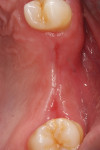 Fig 6. Healing at 12 months post-grafting demonstrated ridge healing and the absence of inflammation.