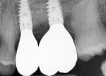 Fig 8. Radiograph 2.5 years post-restoration (more than 3 years post–graft placement) demonstrating stability of the graft and maintenance crestally under functional loading.