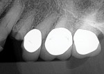 Fig 9. Periapical radiograph demonstrating fracture of the maxillary left first premolar with loss of tooth structure coronal to the crestal bone, leaving the tooth nonrestorable.