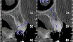 Fig 10. CBCT cross-section view of the affected tooth.