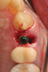 Fig 11. After extraction, an immediate implant was placed into the socket palatally leaving a large gap between the implant and buccal socket wall.