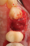 Fig 12. An autogenous dentin graft created from the extracted tooth was placed into the void in the socket to fill the defect.