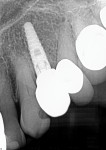 Fig 13 and Fig 14. Periapical radiograph (Fig 13) and clinical appearance (Fig 14) 12 months post–restorative treatment of the implant demonstrating intimate contact of the surrounding bone with the implant and a complete blending of the autogenous dentin graft that had been placed at implant placement. Healthy gingival tissue around the prosthetics is evident.
