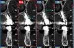 Fig 15. CBCT scan at 51 months post-treatment demonstrating maintenance of bone around the implant with stability of the autogenous dentin graft on the buccal aspect of the site.