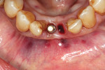 Fig 17. After extraction of the failing central incisor, insufficient mesiodistal space was evident that precluded the use of an implant to replace the extracted incisor.