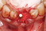 Fig 18. Autogenous dentin graft created from the extracted tooth was placed into the extraction socket and around the implant crestally.