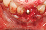 Fig 19. Amnion-chorion membrane was placed to cover the graft and was tucked under the flap margins.