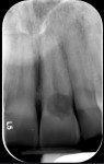 Fig 1 and Fig 2. Preoperative photograph (Fig 1) and radiograph (Fig 2). Note thin biotype with gingival recession around nonrestorable tooth No. 9.