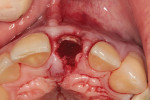 Fig 3. Socket-shield preparation, buccal portion of tooth No. 9.