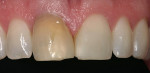 Figure 8  The shade tab in the photograph allows the laboratory technician to gauge the true color of the teeth and the preparations.