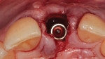 Fig 4. Immediate implant placement without grafting the “shield” compartment.