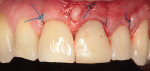 Fig 6. Immediate provisionalization of No. 9. Note coronally positioned gingival margins post-surgery.