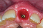 Fig 7. At 4 months postoperative, note healthy peri-implant sulcus with robust stable ridge dimension.