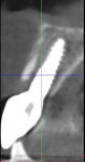 Fig 8. Four-month postoperative CT scan showing socket healing around shield and implant.