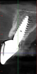 Fig 11 and Fig 12. Five-year CT scans. Note stable facial plate and bone between shield and implant.