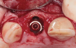 Fig 16. Immediate implant without osseous grafting of the socket–implant gap.