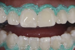 Fig 6. Bleaching was performed in-office in two sessions with a high-concentration gel.