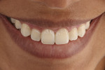 Fig 10. Final smile with esthetic harmony, immediately after application of the resin infiltrant.
