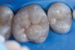 Fig 5. Completion of layering with fine tint line closely mimicking the natural tooth.