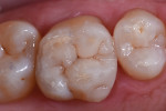 Fig 6. Final occlusal-adjusted view of restoration.