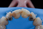 Fig 7 and Fig 8. Preoperative view of rubber dam isolated old composite restorations, frontal view (Fig 7) and occlusal view (Fig 8).