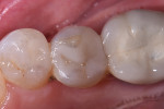 Fig 20. Review of restorations on teeth Nos. 20 and 21 at 9 years.