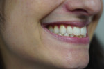 Bite photographs showing the anterior, right posterior, and left posterior tooth relationships.