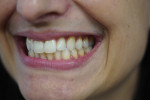 Bite photographs showing the anterior, right posterior, and left posterior tooth relationships.