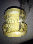 A measurement of 35 mm to 38 mm from the upper buccal fold to the lower buccal fold is typically within the normal range.