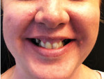 Pretreatment and postoperative photographs of a patient with a gummy smile that was corrected with a full-arch prosthesis.