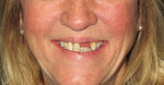 Excessively long teeth can be shortened with the prosthesis as long as sufficient restorative space exists and the VDO can be adjusted.