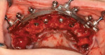 Surgical view of placed implants and a fixation base from a guided surgery system.