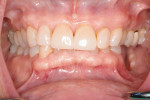 Preoperative retracted frontal view of a severe vertical bone defect in the left posterior mandible that resulted from failed dental implants.