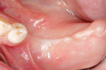 Preoperative occlusal view of the atrophic left posterior mandible.