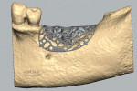 The implant positions and customized titanium mesh were virtually planned in 3D using CAD.