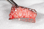 Extraoral view of the customized titanium mesh filled with particulate autograft and xenograft mixed with PRF.