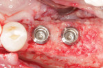 Two tissue level dental implants placed into the reconstructed mandible according to the digital plan.