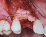 View of labial veneer bone graft covered with a collagen membrane and a connective tissue graft—all stabilized with sutures.