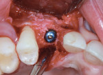 Implant placed with thread exposure on the buccal aspect.